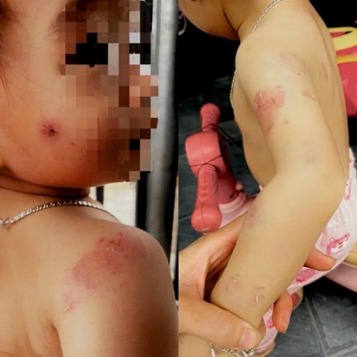 Bé Gái Bầm Tím Ở Trường Mầm Non: Ai Chịu Trách Nhiệm?