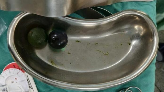 Cảnh Báo: Hạt Nở Đồ Chơi và Nguy Cơ Tắc Ruột Ở Trẻ Nhỏ!