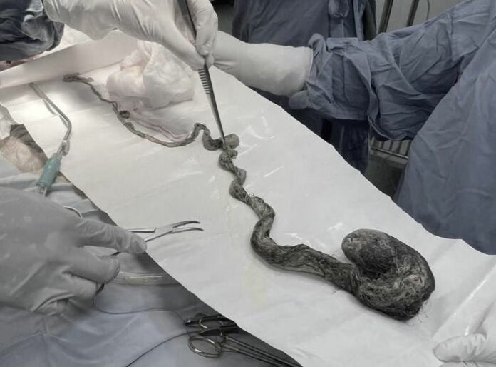 Búi Tóc Khổng Lồ Trong Bụng Bé Trai: Hội Chứng Rapunzel Hiếm Gặp