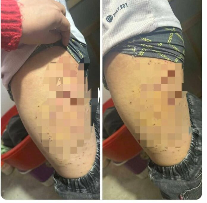 Bạo Lực Học Đường: Vết Bút Bi Đâm Đùi – Lời Cảnh Tỉnh Cho Môi Trường Giáo Dục