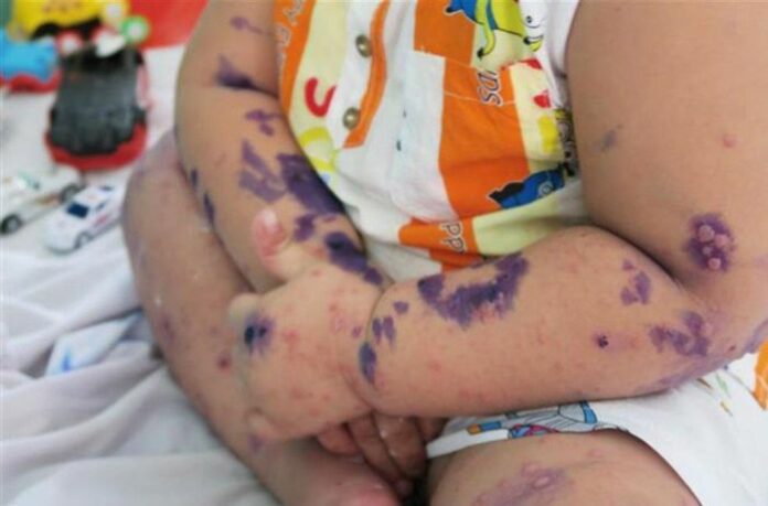 Bệnh Tay Chân Miệng: Hiểm Họa Rình Rập, Cần Hành Động Ngay!