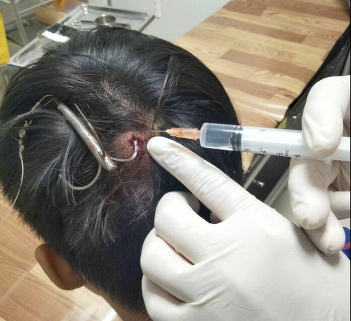 Tai Nạn Móc Câu Cắm Sâu: Bài Học Cảnh Giác Cho Người Đi Câu