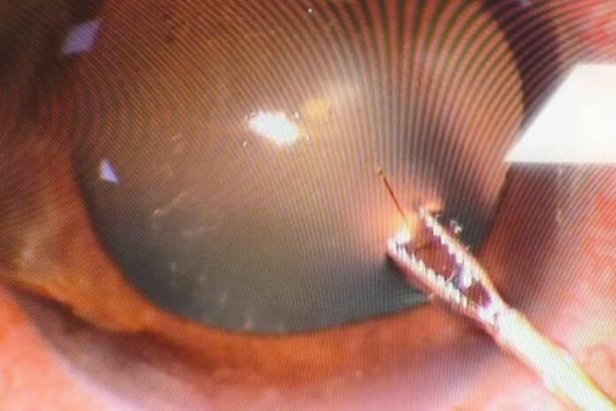 Cận cảnh ngòi ong găm sâu vào mắt, thị lực giảm sút nghiêm trọng