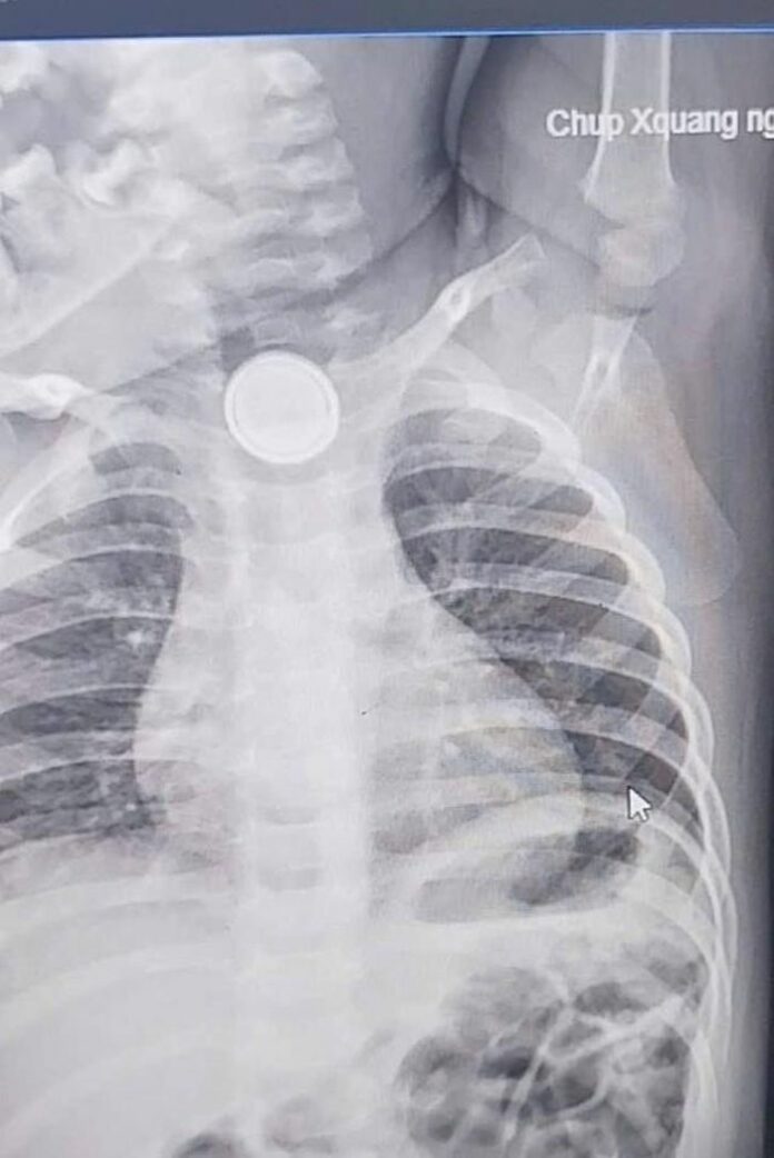 Nguy Hiểm Tiềm Ẩn Khi Trẻ Nuốt Phải Pin Cúc Áo